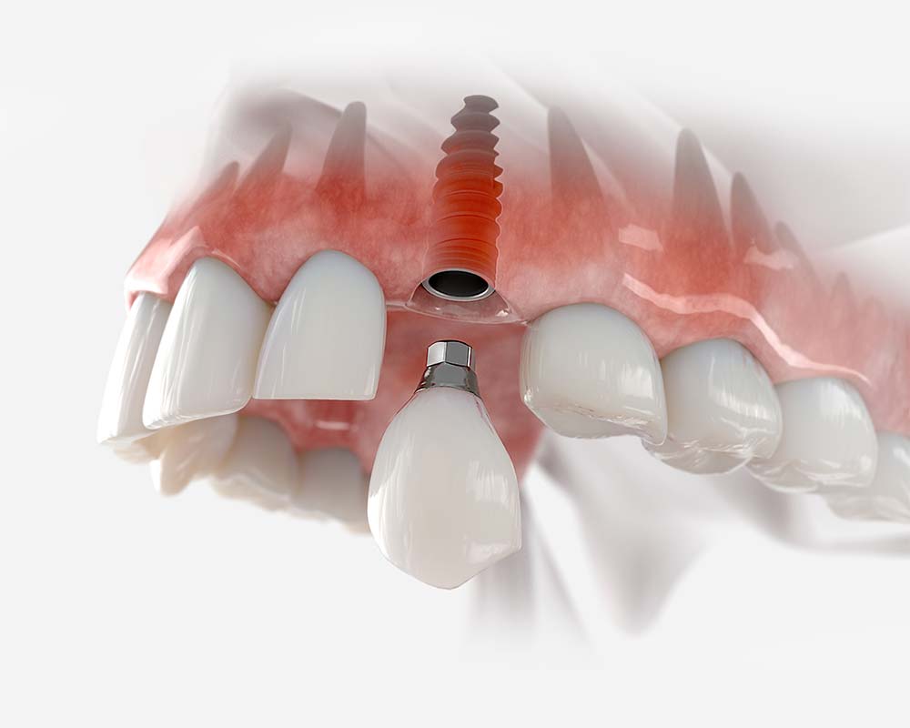Dental implants