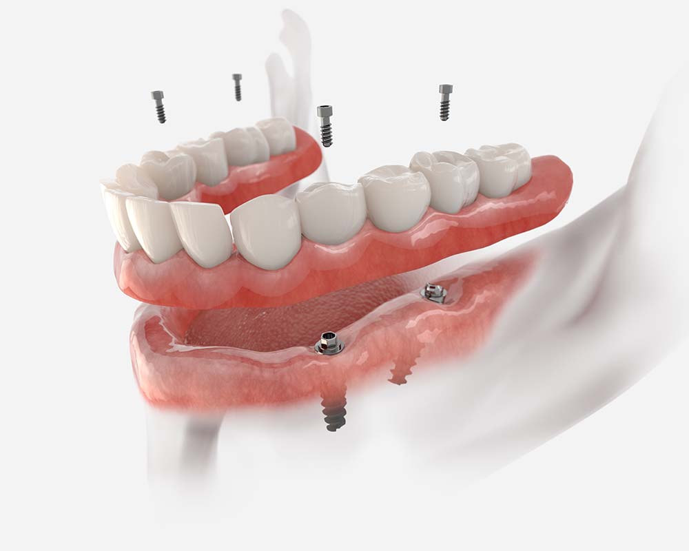 Denture and denture partials
